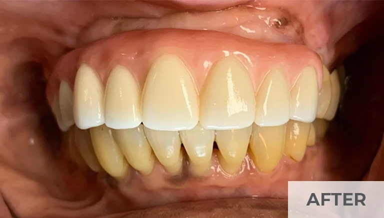 After — fixed, natural-looking upper arch All-on-X smile at Panneton Dental Group