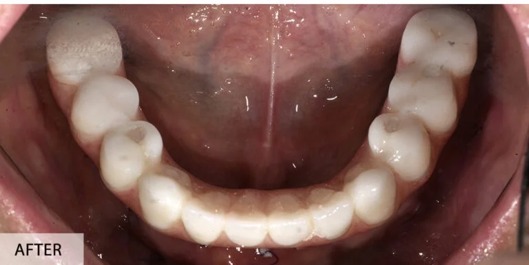 After — implant-supported lower arch with stable, natural smile