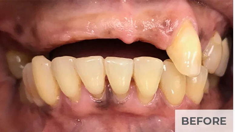 Before — upper arch All-on-X implant restoration at Panneton Dental Group