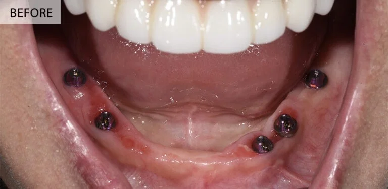 Before — lower arch teeth restored with All-on-X implants at Panneton Dental Group